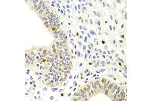 Immunohistochemistry of paraffin-embedded human metrocarcinoma using GEMIN2 antibody at dilution of 1:200 (400x lens). (SIP1 抗体)