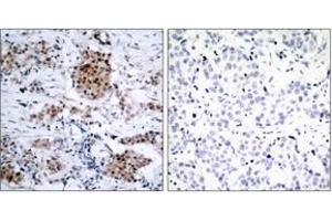 Immunohistochemistry analysis of paraffin-embedded human breast carcinoma, using Estrogen Receptor-alpha (Phospho-Ser167) Antibody. (Estrogen Receptor alpha 抗体  (pSer167))