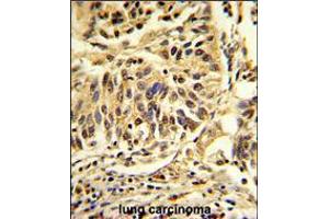 Formalin-fixed and paraffin-embedded human lung carcinoma reacted with CEBPB Antibody , which was peroxidase-conjugated to the secondary antibody, followed by DAB staining. (CEBPB 抗体  (C-Term))