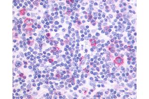 Anti-PTGIR / IP Receptor antibody IHC of human Lymph Node, Hodgkins Lymphoma. (Prostacyclin Receptor 抗体  (N-Term))