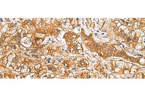 Immunohistochemistry of paraffin-embedded Human liver cancer tissue using RIDA Polyclonal Antibody at dilution of 1:65(x200) (HRSP12 抗体)