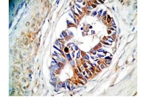 Human stomach cancer tissue was stained by rabbit Anti-Spexin prepro (73-116)  (H) Antiserum (Spexin 抗体  (Preproprotein))