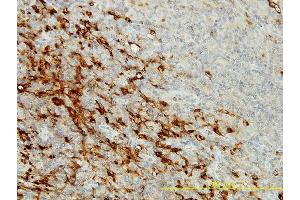 Immunoperoxidase of monoclonal antibody to CPVL on formalin-fixed paraffin-embedded human lymphomar tissue. (CPVL 抗体  (AA 1-476))