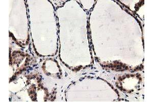Immunohistochemical staining of paraffin-embedded Carcinoma of Human kidney tissue using anti-CBWD1 mouse monoclonal antibody. (CBWD1 抗体)