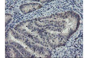 Immunohistochemical staining of paraffin-embedded Adenocarcinoma of Human endometrium tissue using anti-DOK7 mouse monoclonal antibody. (DOK7 抗体)