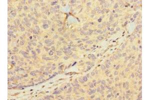 Immunohistochemistry of paraffin-embedded human ovarian cancer using ABIN7155399 at dilution of 1:100 (HIST1H2BD 抗体  (AA 2-57))