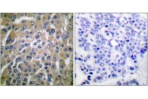Immunohistochemistry analysis of paraffin-embedded human breast carcinoma tissue, using hCG beta Antibody. (HCG beta 抗体  (AA 101-150))