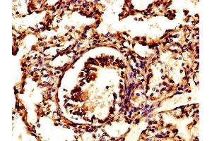 IHC image of ABIN7164840 diluted at 1:500 and staining in paraffin-embedded human lung tissue performed on a Leica BondTM system. (Prosaposin 抗体  (AA 311-391))