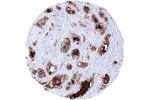 Squamous cell carcinoma showing strong KLK7 staining in areas of keratinization (Kallikrein 7 抗体)
