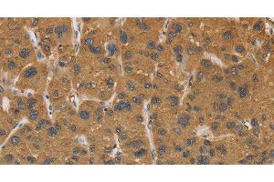 Immunohistochemistry of paraffin-embedded Human liver cancer tissue using CYP17A1 Polyclonal Antibody at dilution 1:30 (CYP17A1 抗体)