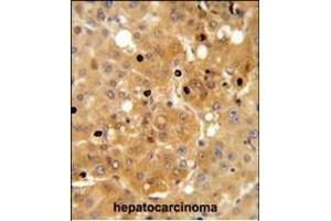 PRK Antibody (ABIN652306 and ABIN2841396) IHC analysis in formalin fixed and paraffin embedded human hepatocarcinoma followed by peroxidase conjugation of the secondary antibody and DAB staining. (PRKAA1 抗体)