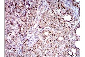 Immunohistochemical analysis of paraffin-embedded cervical cancer tissues using ALDH2 mouse mAb with DAB staining. (ALDH2 抗体  (AA 317-517))