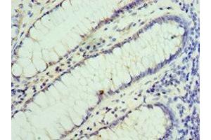 Immunohistochemistry of paraffin-embedded human colon cancer using ABIN7155860 at dilution of 1:100 (VENTX 抗体  (AA 1-258))