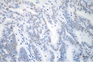 Immunohistochemistry was performed on paraffin-embedded human endometrial carcinoma using TP53BP1 antibody (ABIN7800690), 1:(ABIN7798691). (TP53BP1 抗体)