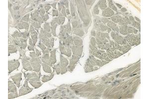 ABIN6261262 and ABIN6276488 at 1/100 staining human tongue carcinoma by IHC-P. (DEFB132 抗体  (Internal Region))