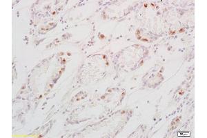 Formalin-fixed and paraffin embedded human gastric carcinoma labeled with Anti-TGF alpha Polyclonal Antibody, Unconjugated (ABIN724415) at 1:200 followed by conjugation to the secondary antibody and DAB staining (TGFA 抗体  (AA 40-89))