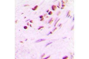 Immunohistochemical analysis of MYF5 staining in human lung cancer formalin fixed paraffin embedded tissue section. (MYF5 抗体  (Center))