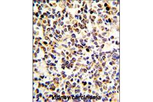 Formalin-fixed and paraffin-embedded human kidney carcinoma with KRT10 Antibody (N-term), which was peroxidase-conjugated to the secondary antibody, followed by DAB staining. (Keratin 10 抗体  (N-Term))