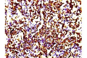 IHC image of ABIN7127297 diluted at 1:100 and staining in paraffin-embedded human lung cancer performed on a Leica BondTM system. (Recombinant HIST1H4A 抗体)