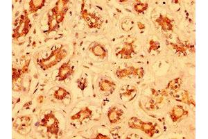 IHC image of ABIN7160478 diluted at 1:400 and staining in paraffin-embedded human breast cancer performed on a Leica BondTM system. (MZF1 抗体  (AA 186-354))