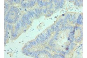 Immunohistochemistry of paraffin-embedded human colon cancer using ABIN7152098 at dilution of 1:100 (Elf4 抗体  (AA 1-200))