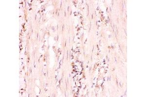 IHC-P: MRP4 antibody testing of human intestinal cancer tissue (ABCC4 抗体  (AA 1-370))