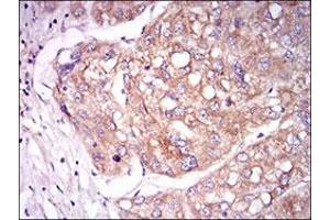 Immunohistochemical staining of human liver cancer tissues with TIE1 monoclonal antibody, clone 8D12B10  at 1:200-1:1000 dilution. (TIE1 抗体  (AA 385-607))