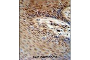 ZNF324B antibody (C-term) (ABIN654564 and ABIN2844270) immunohistochemistry analysis in formalin fixed and paraffin embedded human skin carcinoma followed by peroxidase conjugation of the secondary antibody and DAB staining. (ZNF324B 抗体  (C-Term))