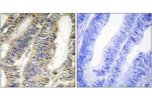 Immunohistochemistry analysis of paraffin-embedded human colon carcinoma tissue, using TNFA Antibody. (TNF alpha 抗体  (AA 141-190))