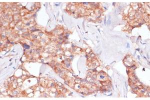Immunohistochemistry of paraffin-embedded Human breast cancer using TIMM8B Polyclonal Antibody at dilution of 1:100 (40x lens). (TIMM8B 抗体)