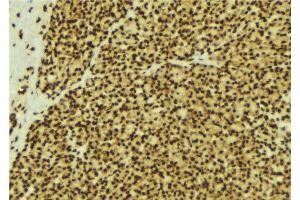 ABIN6269300 at 1/100 staining Human breast cancer tissue by IHC-P. (SMAD3 抗体  (C-Term))