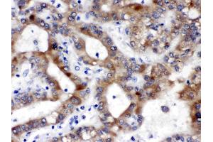 ALDH3A2 was detected in paraffin-embedded sections of human liver cancer tissues using rabbit anti- ALDH3A2 Antigen Affinity purified polyclonal antibody (Catalog # ) at 1 µg/mL. (ALDH3A2 抗体  (AA 1-100))