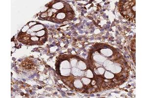 ABIN6266573 at 1/200 staining human colon carcinoma tissue sections by IHC-P. (KRT20 抗体  (C-Term))