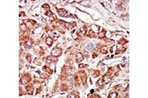 IHC analysis of FFPE human hepatocarcinoma stained with the PKR antibody (EIF2AK2 抗体  (AA 11-42))