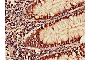 Immunohistochemistry of paraffin-embedded human colon cancer using ABIN7175954 at dilution of 1:100 (YAF2 抗体  (AA 1-204))