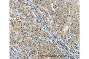 Immunohistochemistry of Human thyroid cancer using PKD1 Polyclonal Antibody at dilution of 1:40