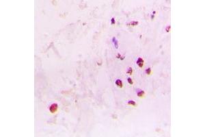 Immunohistochemical analysis of RAD17 staining in human lung cancer formalin fixed paraffin embedded tissue section. (RAD17 抗体  (C-Term))