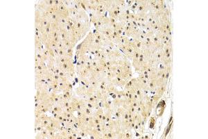 Immunohistochemistry of paraffin-embedded human gastric cancer using TERF1 antibody (ABIN6292425) at dilution of 1:200 (40x lens). (TRF1 抗体)