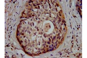 IHC image of ABIN7154126 diluted at 1:500 and staining in paraffin-embedded human cervical cancer performed on a Leica BondTM system. (Glutathione Synthetase 抗体  (AA 290-418))