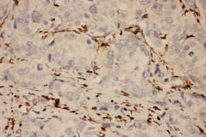 Anti-COX1 Picoband antibody,  IHC(P): Human Mammary Cancer Tissue (PTGS1 抗体  (AA 318-599))