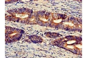 Immunohistochemistry of paraffin-embedded human colon cancer using ABIN7174508 at dilution of 1:100 (UFM1 抗体  (AA 11-63))