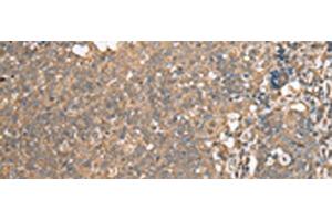 Immunohistochemistry of paraffin-embedded Human cervical cancer tissue using ECI1 Polyclonal Antibody at dilution of 1:30(x200) (DCI 抗体)