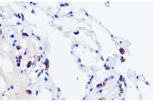 Immunohistochemistry of paraffin-embedded Human lung using SFTPC Polyclonal Antibody at dilution of 1:200 (40x lens). (Surfactant Protein C 抗体)