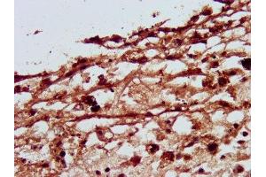 IHC image of ABIN7162742 diluted at 1:500 and staining in paraffin-embedded human melanoma performed on a Leica BondTM system. (SLC26A4 抗体  (AA 592-655))