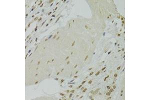 Immunohistochemistry of paraffin-embedded human gastric cancer using XRCC6 Antibody.