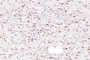 Immunohistochemistry analysis of paraffin-embedded human gastric cancer using NMU (ABIN7074818) at dilution of 1: 1000 (Neuromedin U 抗体)