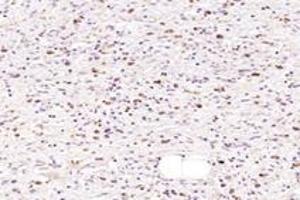Immunohistochemistry analysis of paraffin-embedded human gastric cancer using NMU (ABIN7074818) at dilution of 1: 1000 (Neuromedin U 抗体)