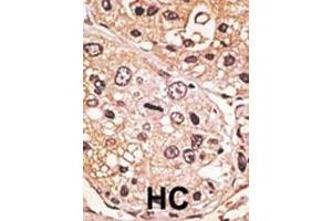 Formalin-fixed and paraffin-embedded human cancer tissue reacted with the primary antibody, which was peroxidase-conjugated to the secondary antibody, followed by AEC staining. (GDF9 抗体  (N-Term))