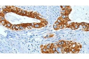 Immunohistochemistry of paraffin-embedded Human cervical cancer using KRT40 Polyclonal Antibody at dilution of 1:50 (KRT40 抗体)