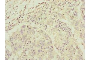 Immunohistochemistry of paraffin-embedded human liver cancer using ABIN7148369 at dilution of 1:100 (C8A 抗体  (AA 310-460))